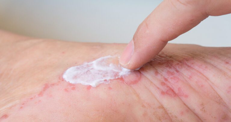 Treatment of hives 