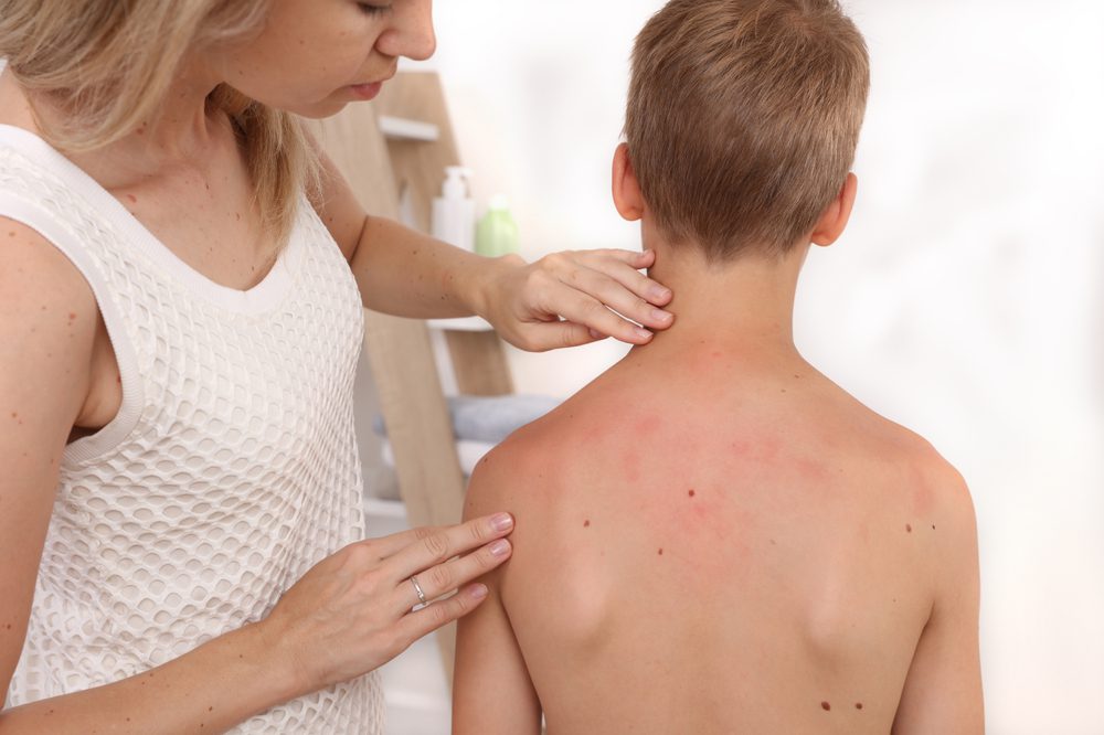 Hives are Contigues