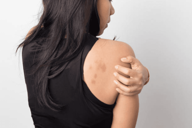Risks of Having Hives