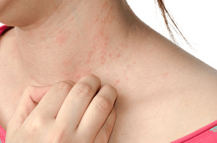 What Infections Can Cause Hives