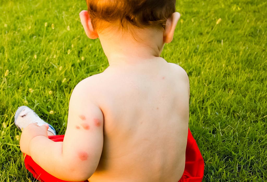 Hives In Children
