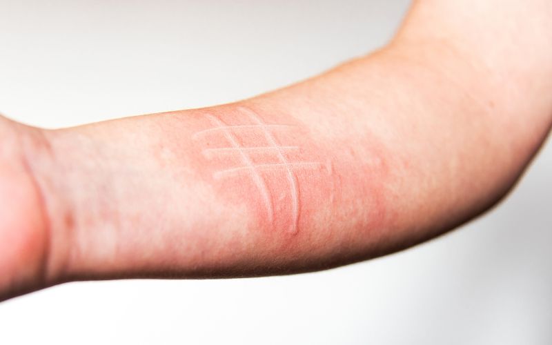 dermatographism