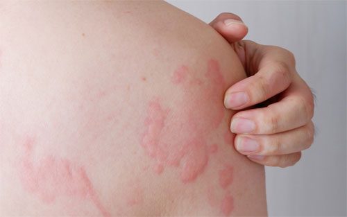 hives symptoms