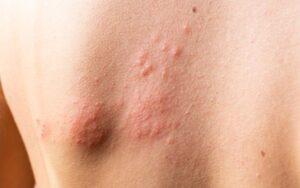what is hives