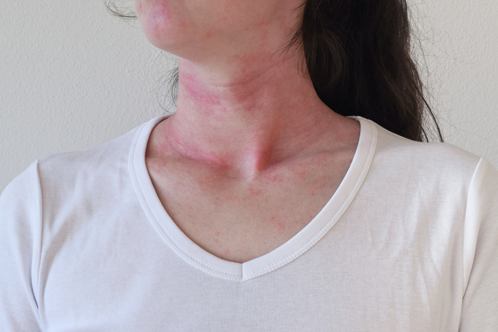Causes of acute hives