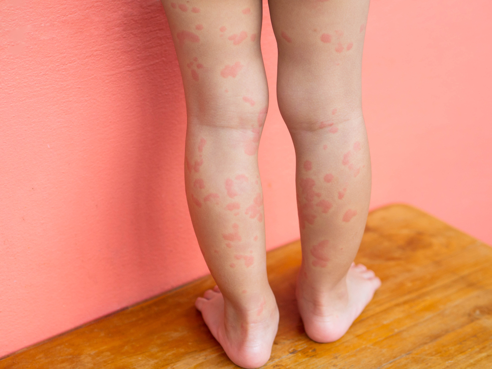 Complications of hives in children