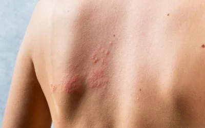 Hives on Skin and Body – Hives Treatment