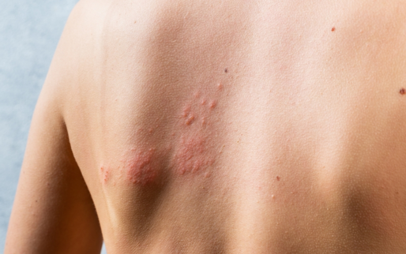 HIVES ON SKIN AND BODY