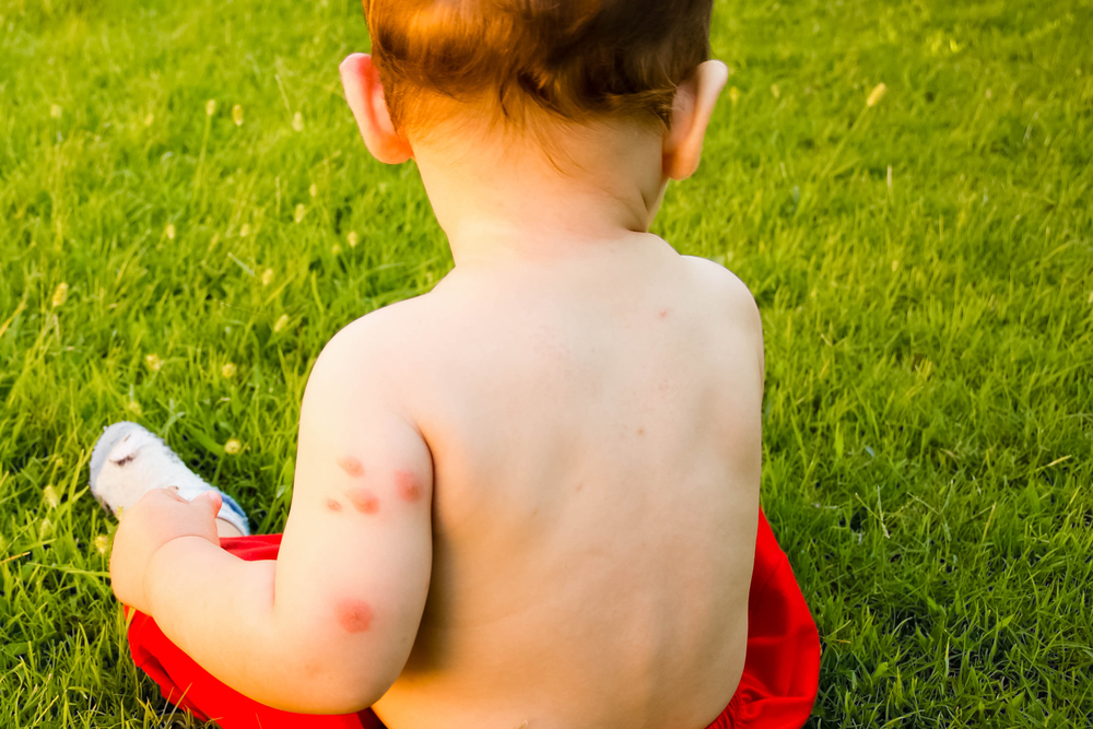 How Common Are Hives In Children? Complications & Prognosis
