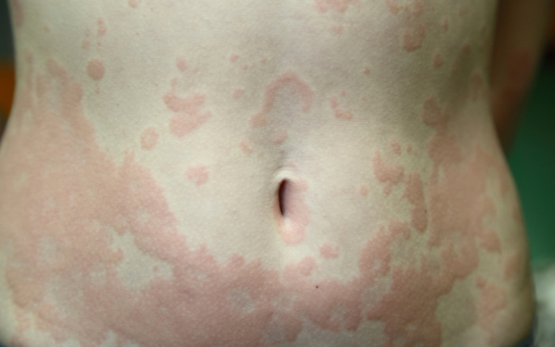 hives appearance