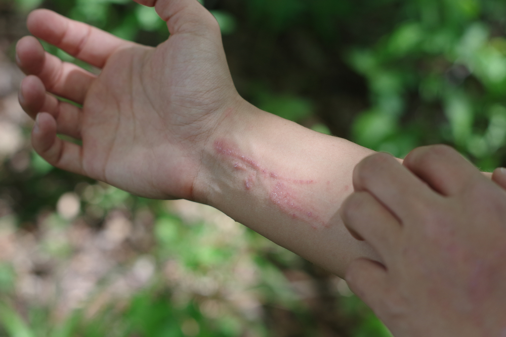 Avoid scratching the skin