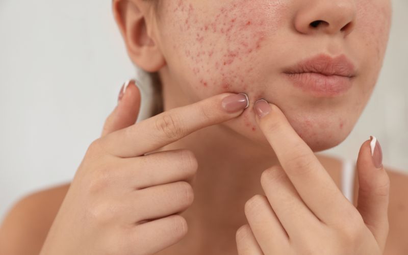 What Are Blemishes on Face and How to Remove Them?