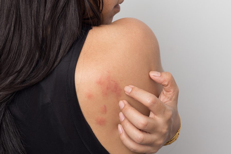 What are Chronic Hives-Symptoms & Causes?