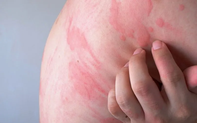 5 Simple And Effective Ways For Fast Relief Of Hives At Home