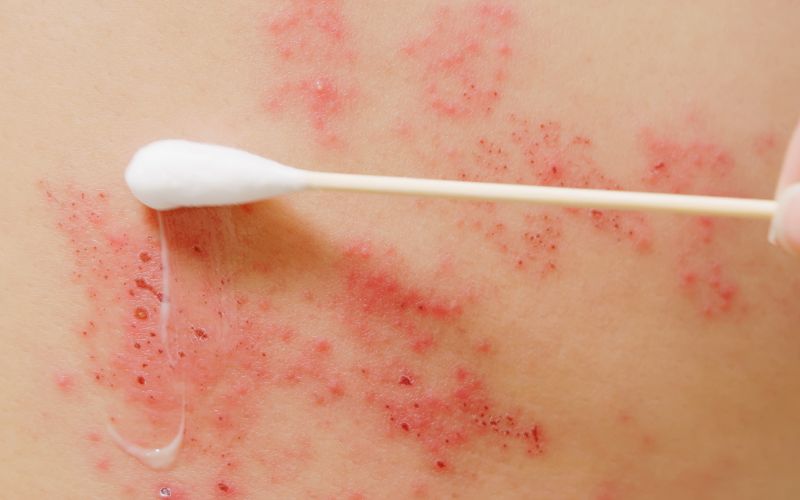 Hives