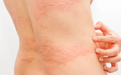 Can cancer cause hives and itching?