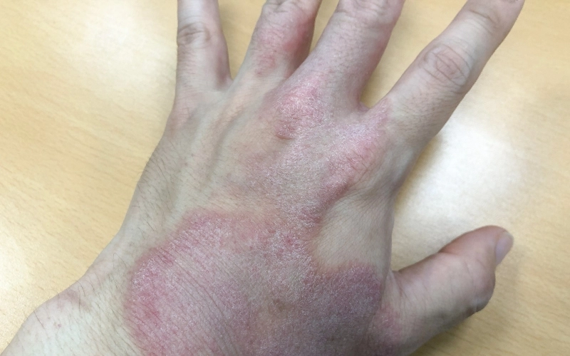 Understanding Idiopathic Chronic Urticaria (Chronic Hives)