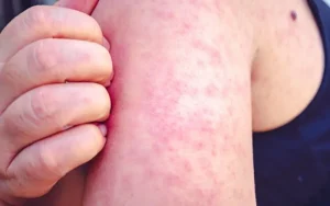 Idiopathic Chronic Urticaria and Pruritus