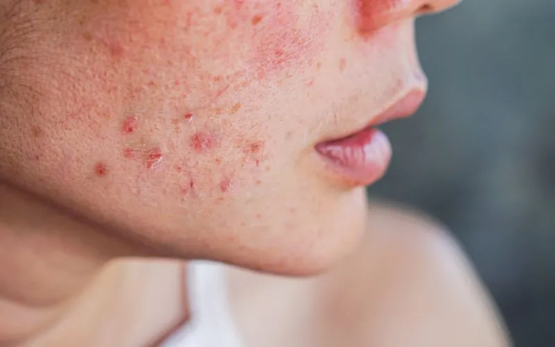 Location of Social Anxiety Hives