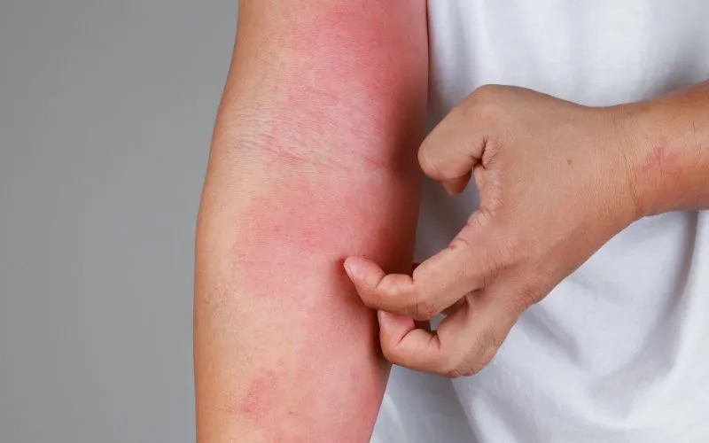 What is Amoxicillin Hives or Penicillin Allergy?