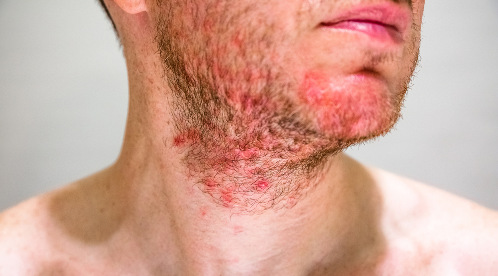 Hives caused by shaving