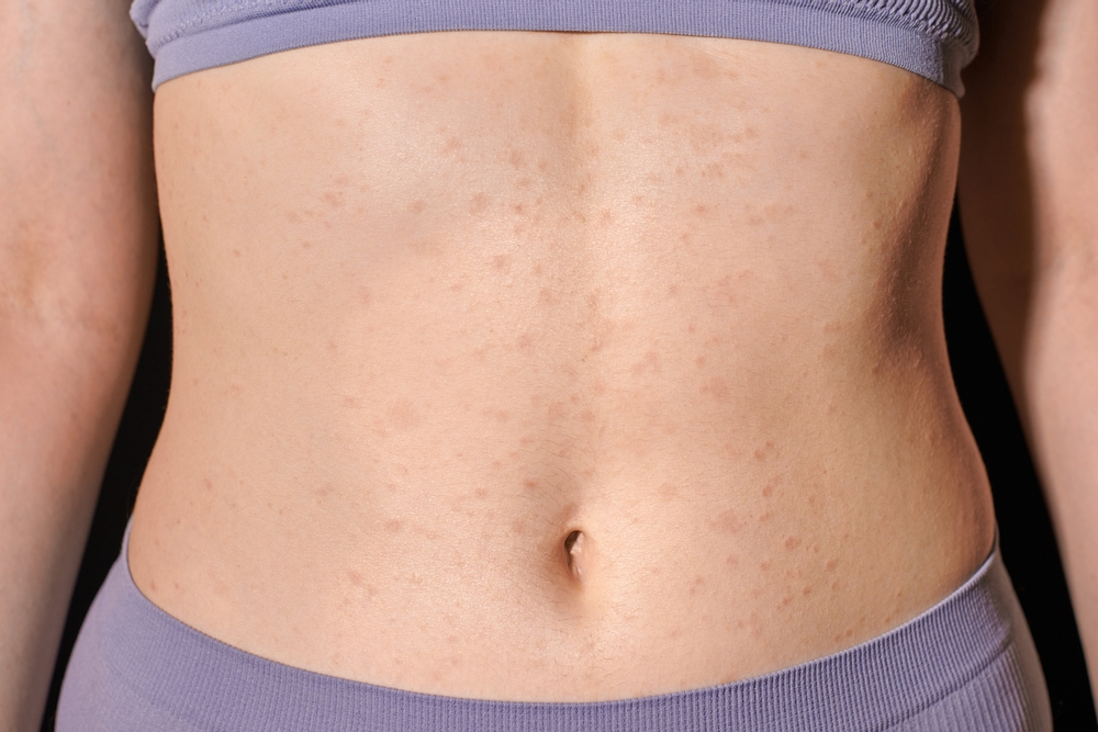 Leukemia Hives 