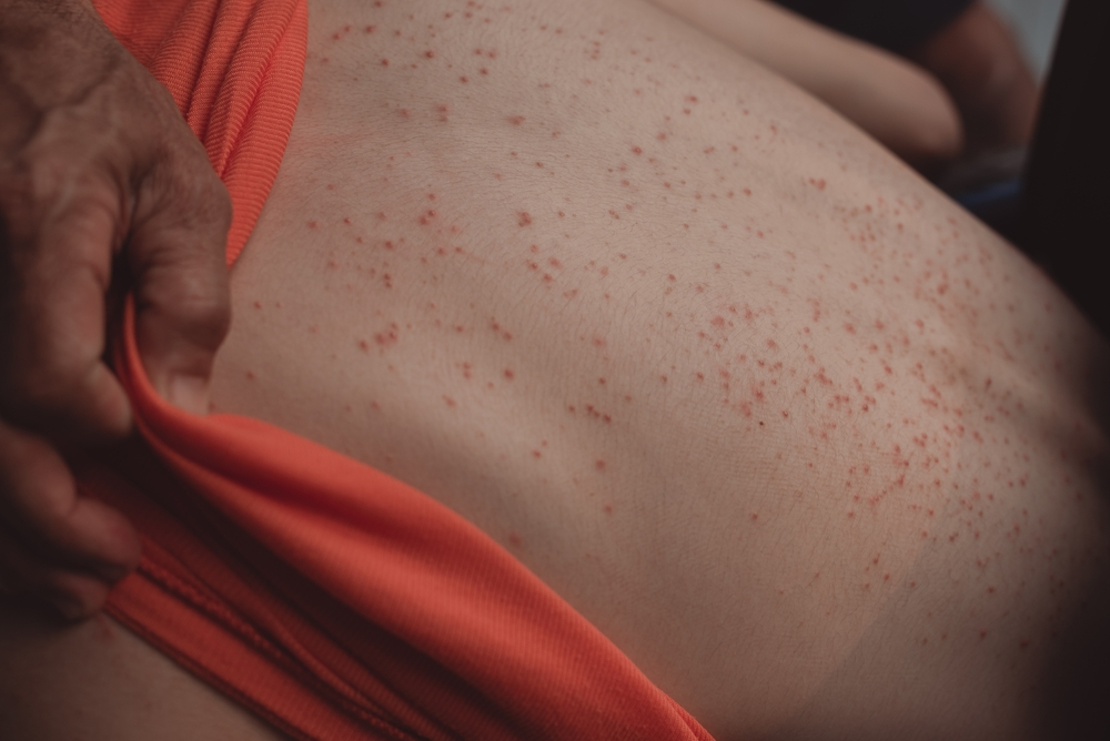 What type of cancer can cause hives