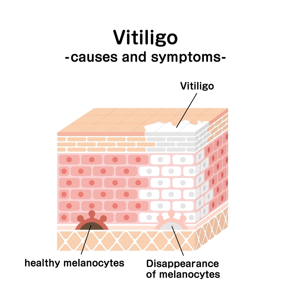 Causes and symptoms of vitiligo on pale skin