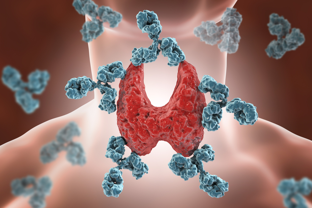Causes of Hashimoto disease