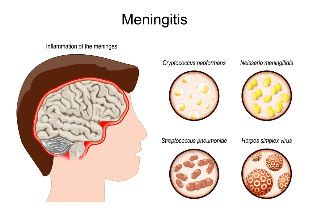 Causes of meningitis
