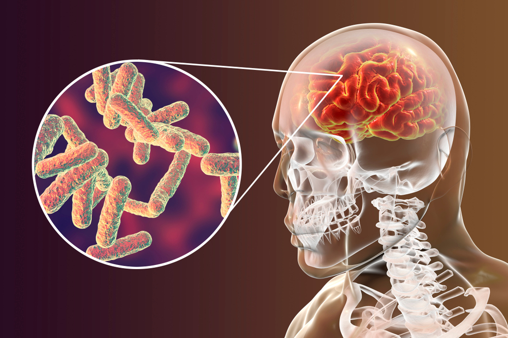 Meningitis Meningitis