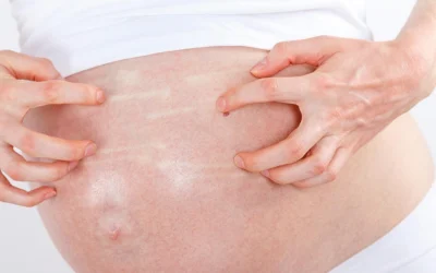 Pruritus with pregnancy: Causes and Management