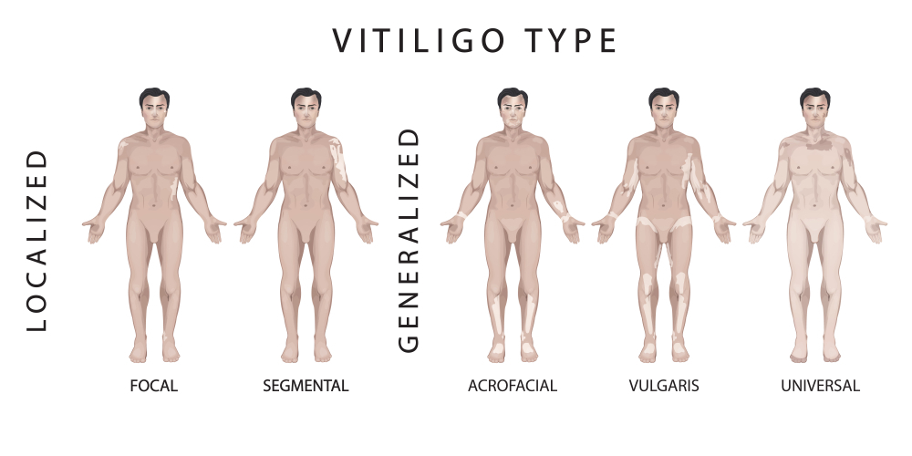 Types of vitiligo on pale skin