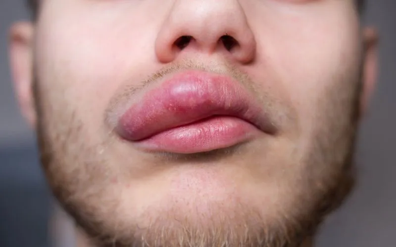 Angioedema