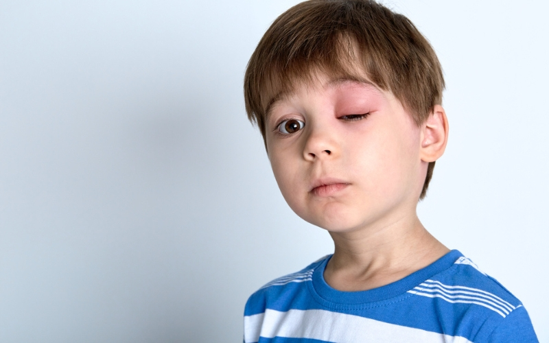 Swelling of eye because of angioedema