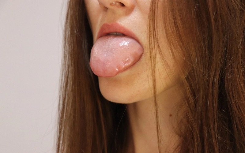 Complication of angioedema in hives