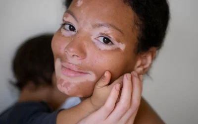 Vitiligo Signs and Symptoms: What to Look For