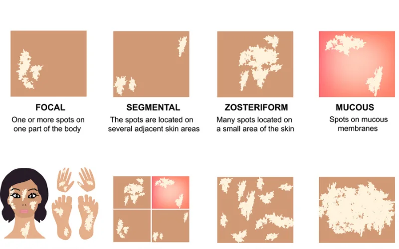 vitiligo signs