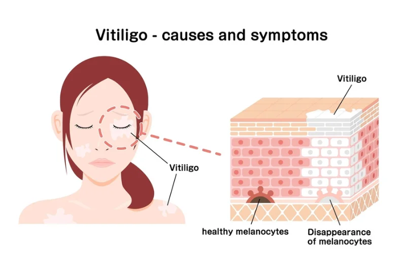 vitiligo signs