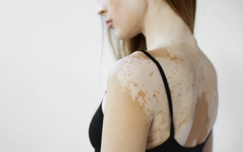 vitiligo signs