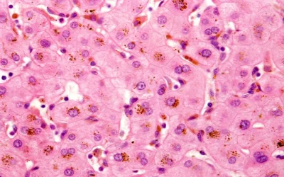 Cholestasis Liver Disease: Symptoms, Causes, and Treatment Options