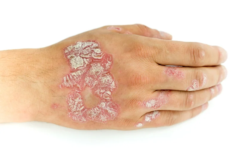 white patches skin fungus