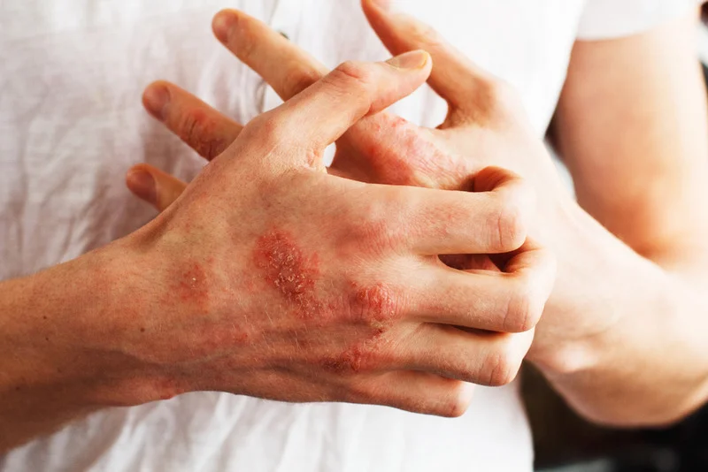 white patches skin fungus