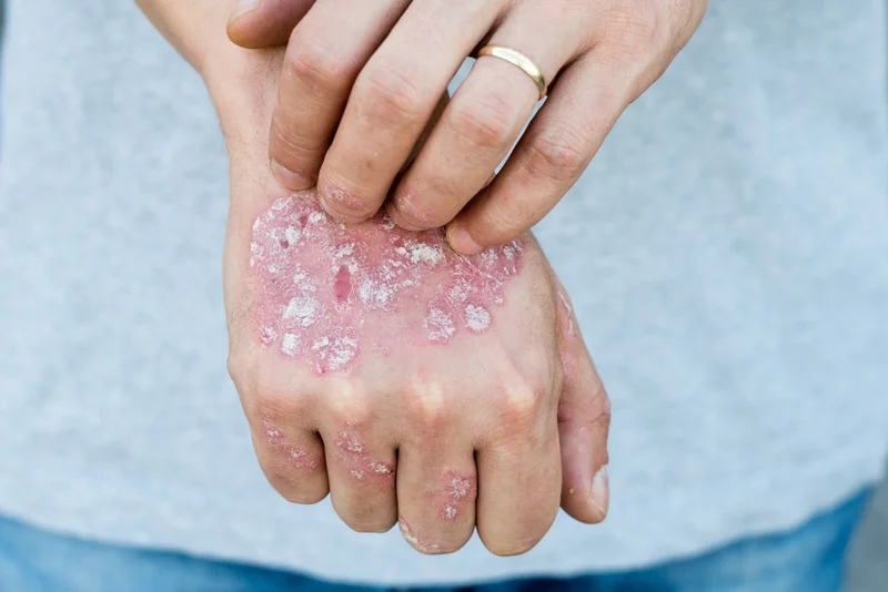 white patches skin fungus