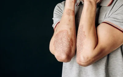 White Patches Skin Fungus: Identification, Treatment, and Prevention