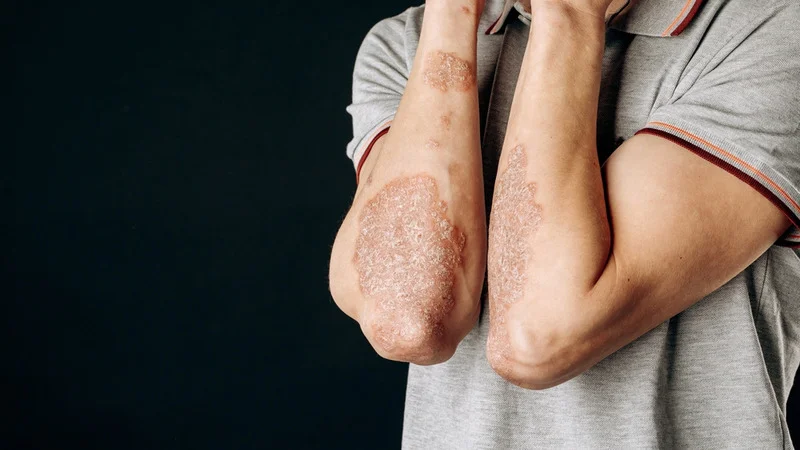 white patches skin fungus