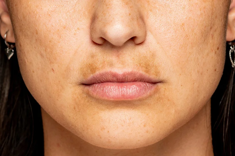 skin discoloration