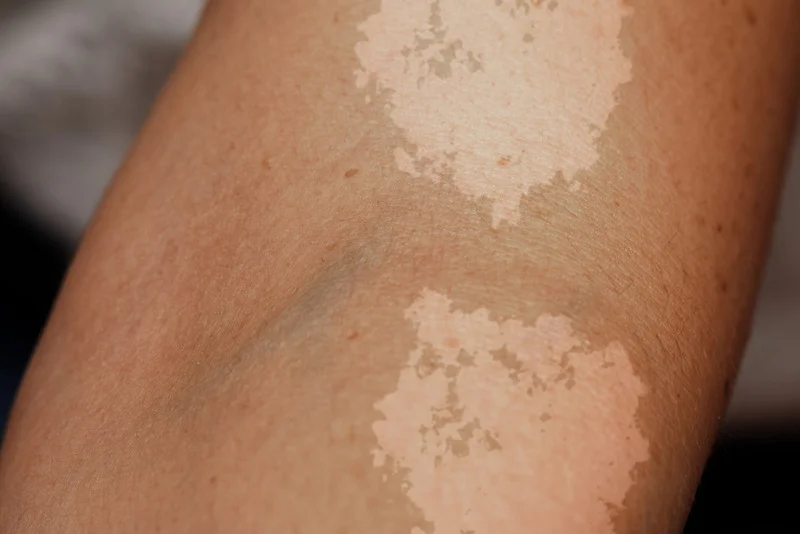 skin discoloration