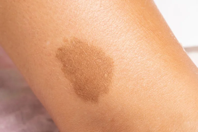 skin discoloration
