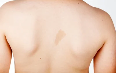 Skin Discoloration: Causes, Treatment, and Prevention